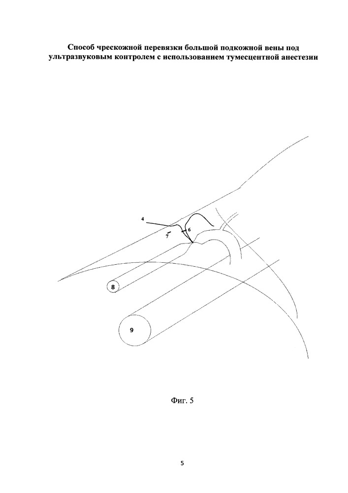 Способ чрескожной перевязки большой подкожной вены под ультразвуковым контролем с использованием тумесцентной анестезии (патент 2651081)