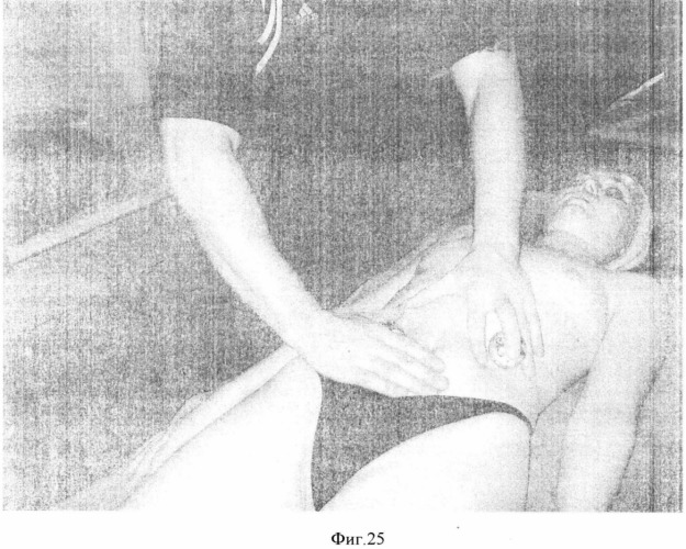 Способ моделирования фигуры при консервативном лечении ожирения (патент 2364387)