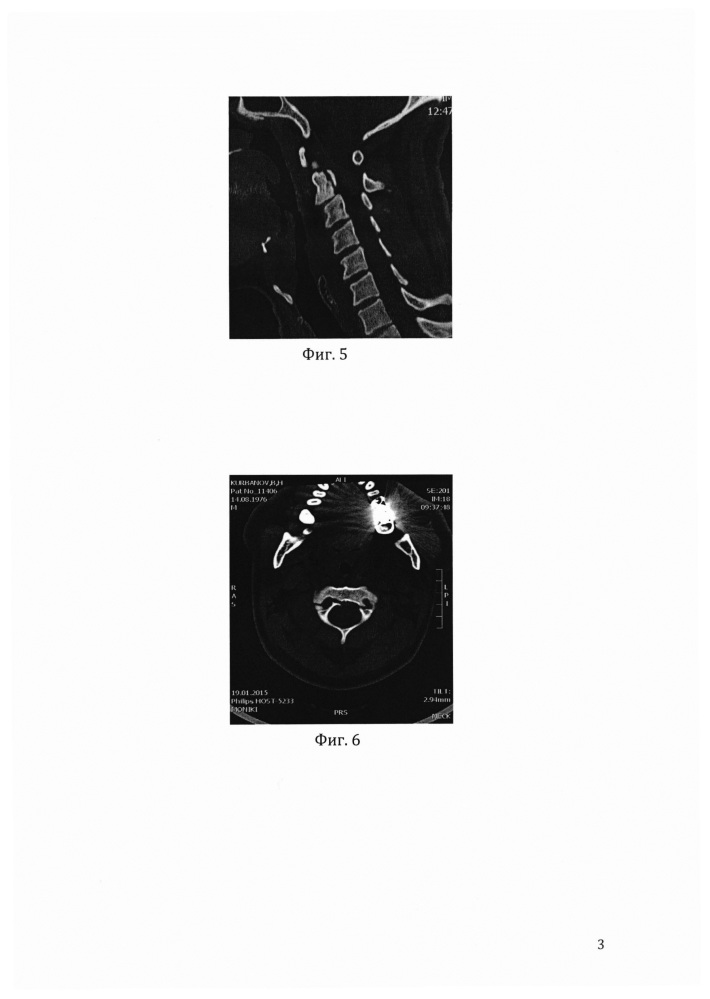 Способ лечения повреждений с2 позвонка (патент 2641160)