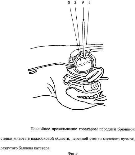 Способ надлобковой цистостомии при внебрюшинном нарушении целостности стенок мочевого пузыря (патент 2522385)
