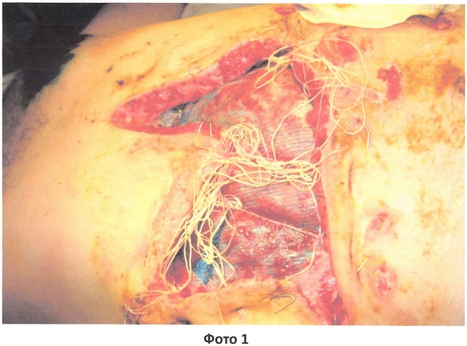 Способ лечения обширных раневых дефектов передней брюшной стенки (патент 2408291)
