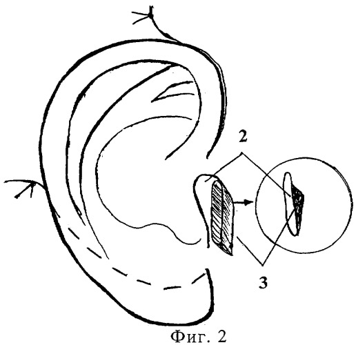 Способ формирования козелка ушной раковины (патент 2284764)