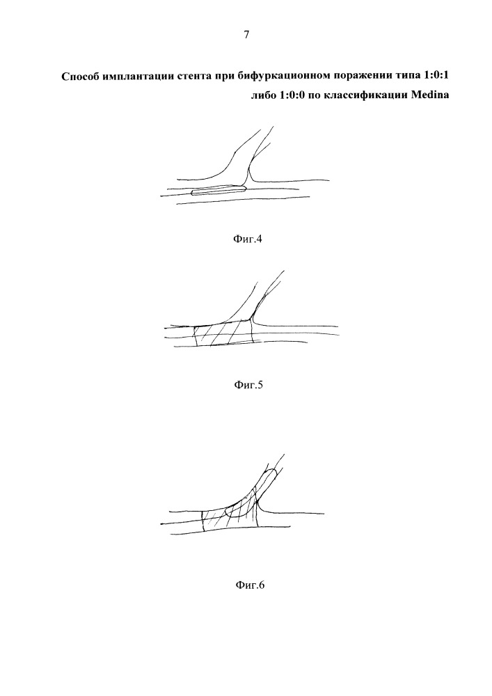 Способ имплантации стента при бифуркационном поражении типа 1:0:1 либо 1:0:0 по классификации medina (патент 2664614)