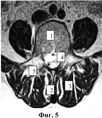 Способ реконструкции позвоночного канала при опухоли спинного мозга (патент 2567824)
