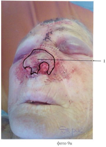 Способ восстановления наружного носа при субтотальных дефектах (патент 2452403)