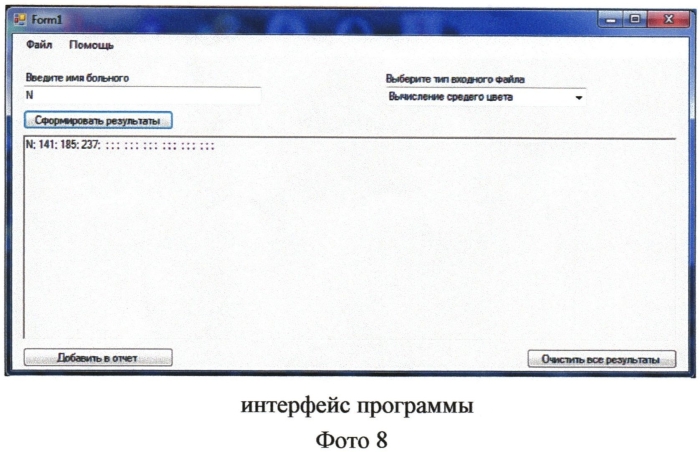 Способ динамического контроля за состоянием диска зрительного нерва при заболеваниях зрительного нерва. (патент 2556567)