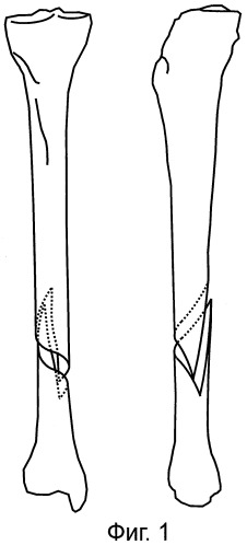 Способ определения направления и величины ротационного смещения отломков большеберцовой кости (патент 2452381)