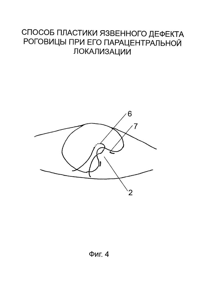 Способ пластики язвенного дефекта роговицы при его парацентральной локализации (патент 2644297)