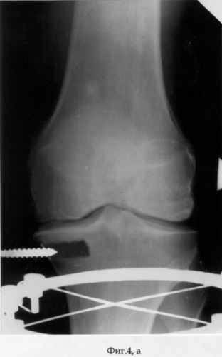Способ лечения деформирующего артроза коленного сустава (патент 2286736)
