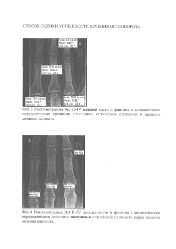 Способ оценки успешности лечения остеопороза (патент 2585403)