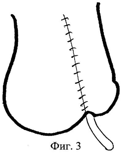 Способ хирургического лечения осложненных форм стволовой гипоспадии (патент 2284156)