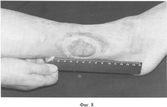 Способ лечения трофических язв нижних конечностей при посттромботической болезни (патент 2328288)