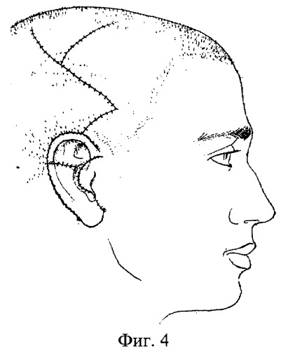 Способ устранения дефекта ушной раковины (патент 2360622)