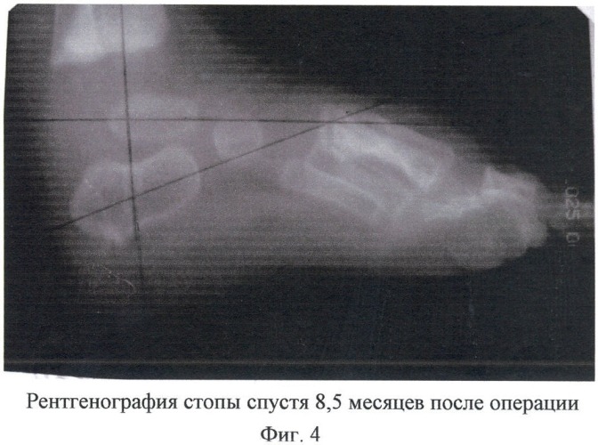 Способ лечения и профилактики вторичных деформаций при хирургической коррекции косолапости у детей первого года жизни (патент 2408312)