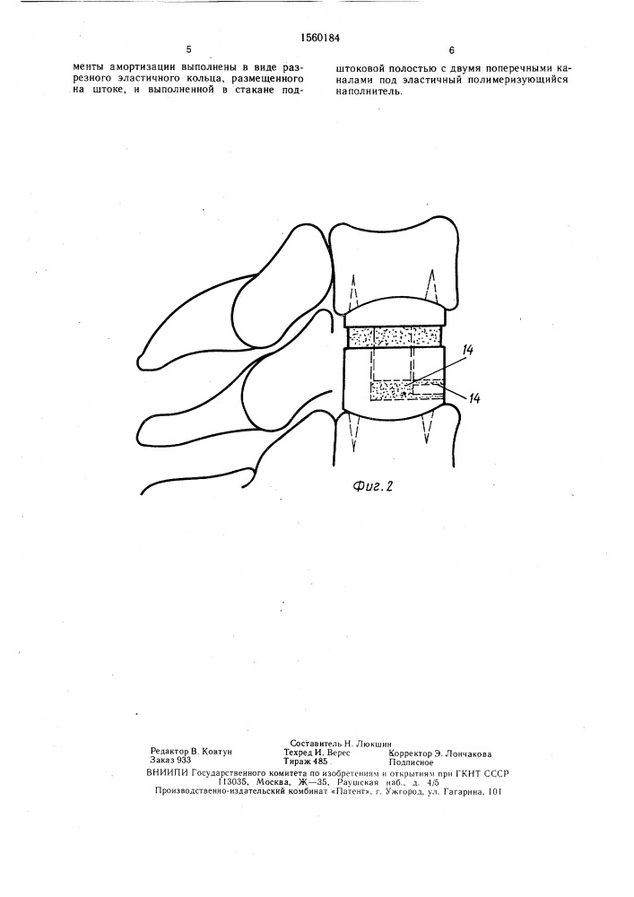 Эндопротез сегмента позвоночника (патент 1560184)