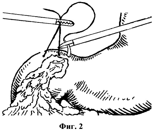 Способ лапароскопической ликвидации перфорации пилородуоденальной язвы (патент 2397727)