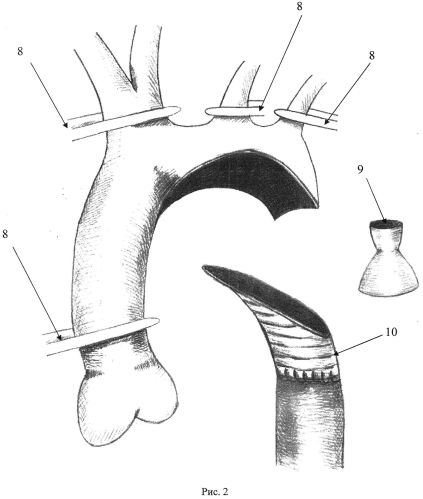 Способ коррекции коарктации и рекоарктации аорты в сочетании с гипоплазией дуги аорты (патент 2563436)