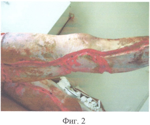 Способ некротомии при термической травме (патент 2342909)