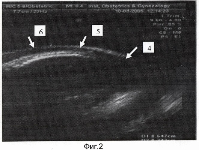 Способ оценки функционального состояния нижнего сегмента матки у беременных женщин после кесарева сечения (патент 2388410)