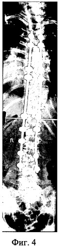Способ лечения сколиоза (патент 2445935)