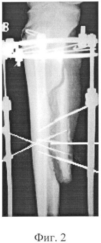 Способ остеосинтеза при лечении больных с ишемическими поражениями конечностей (патент 2354321)