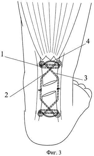 Способ ахиллопластики (патент 2357693)