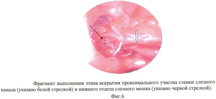 Способ хирургического лечения хронического дакриоцистита (патент 2532014)