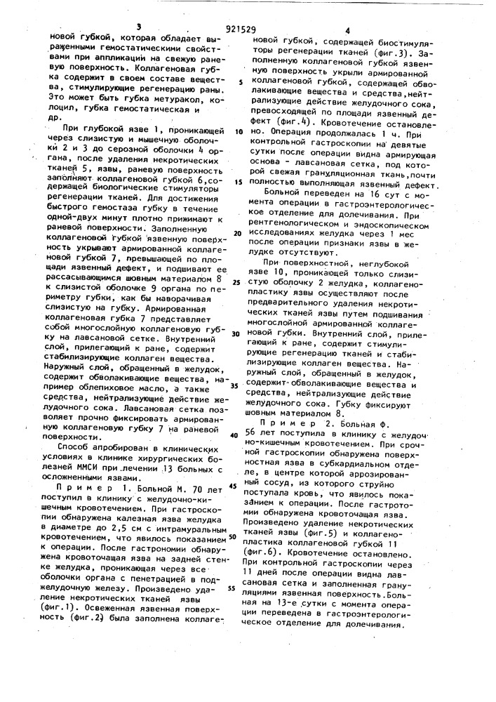 Способ лечения кровоточащих язв желудка и двенадцатиперстной кишки (патент 921529)