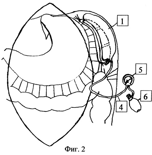 Устройство для фиксации селезенки в операционной ране (патент 2253388)