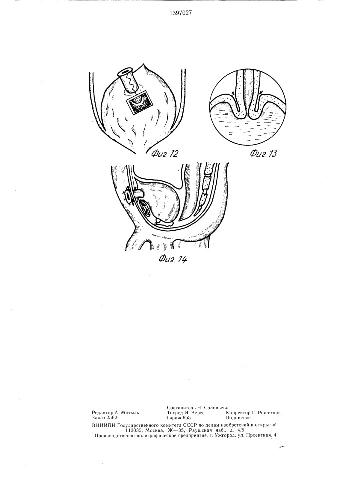 Устройство для формирования инвагинационного клапана (патент 1397027)