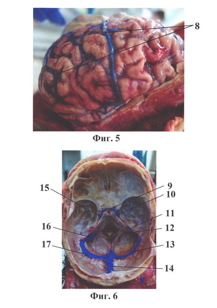 Способ визуализации артериальных и венозных сосудов основания черепа и головного мозга человека для их топографо-анатомического исследования (патент 2621419)