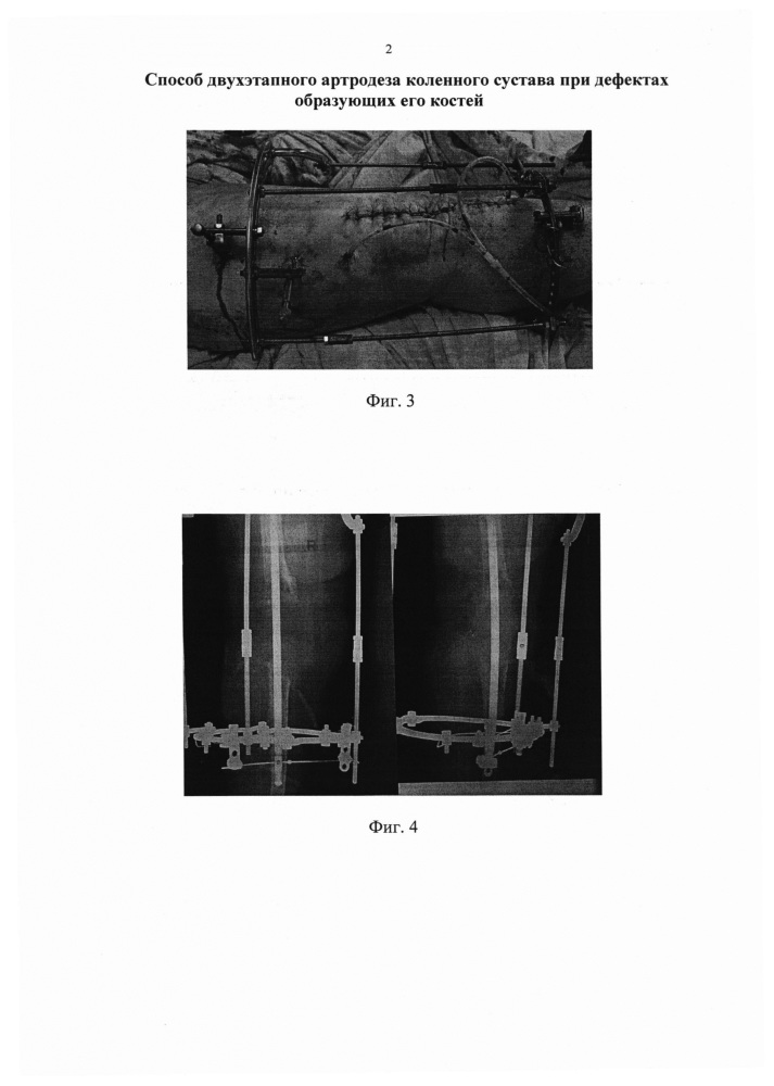 Способ двухэтапного артродеза коленного сустава при дефектах образующих его костей (патент 2648863)