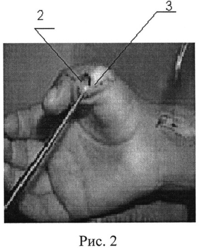 Способ устранения сгибательно-приводящей контрактуры первого пальца кисти у больных с детским церебральным параличом (патент 2537772)