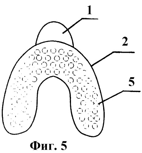 Индивидуальная ложка куретовых для снятия оттиска на беззубую челюсть (два варианта) (патент 2481804)