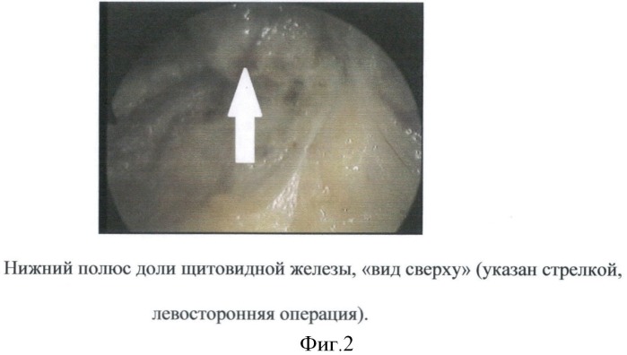 Способ эндовидеохирургической гемитиреоидэктомии (патент 2511461)