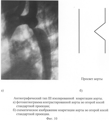 Способ диагностики изолированной коарктации аорты и способ выбора тактики ее лечения (патент 2244510)