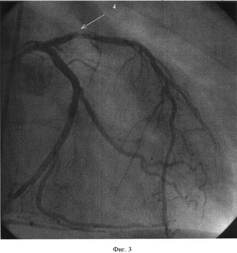 Способ прогнозирования распространенности стенотического поражения коронарного русла трансплантата у реципиентов после трансплантации сердца (патент 2426124)