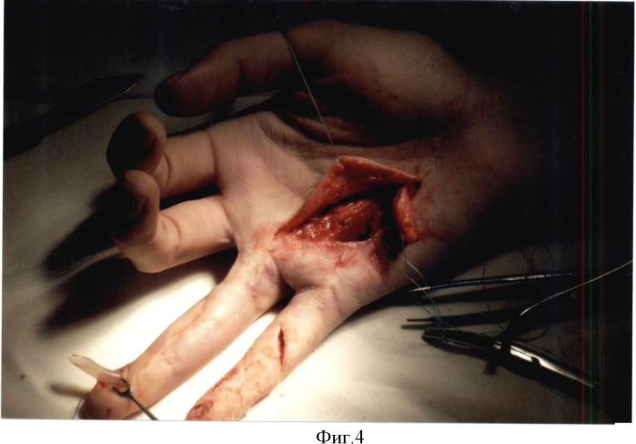 Способ сохранения сухожильного канала пальца при гнойном осложнении на первом этапе тендопластики (патент 2514347)