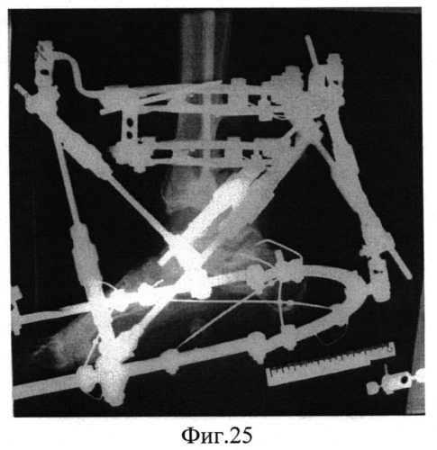 Способ остеосинтеза аппаратом орто-сув для устранения вывихов в голеностопном суставе (патент 2547798)