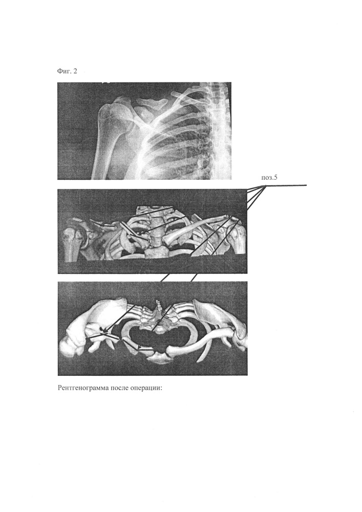Способ лечения врожденного ложного сустава ключицы, образованного деформированными фрагментами ключицы у детей (патент 2651124)