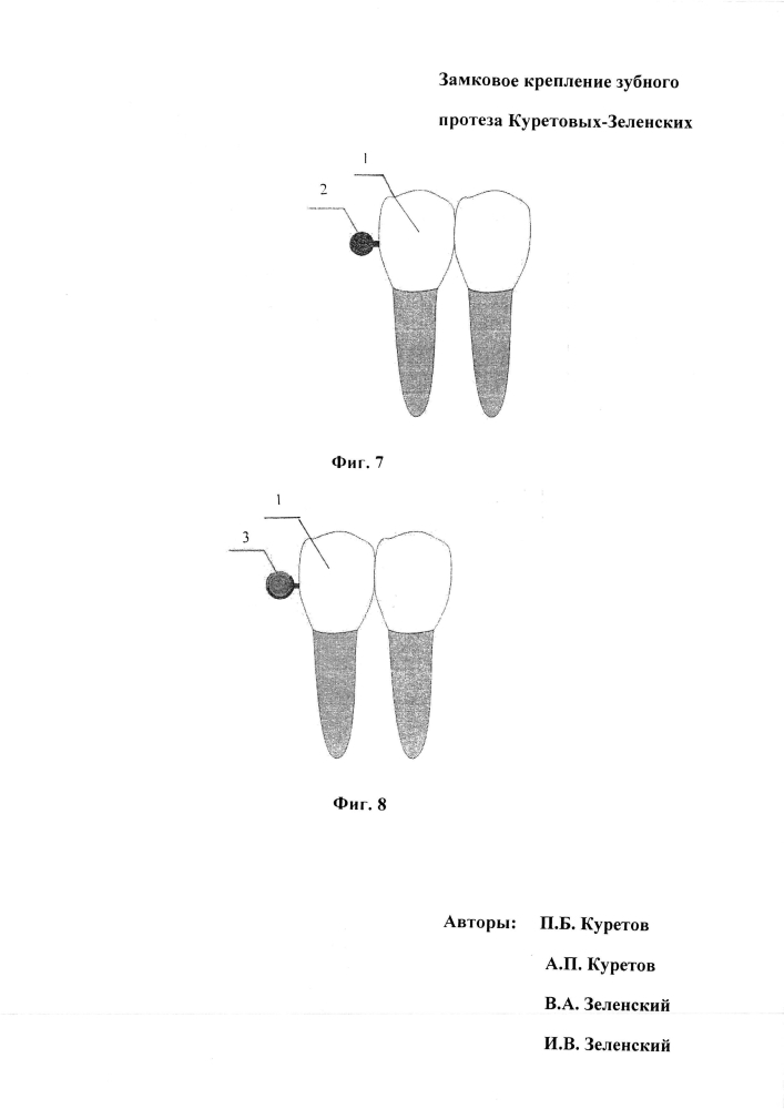 Замковое крепление зубного протеза куретовых-зеленских (патент 2595007)