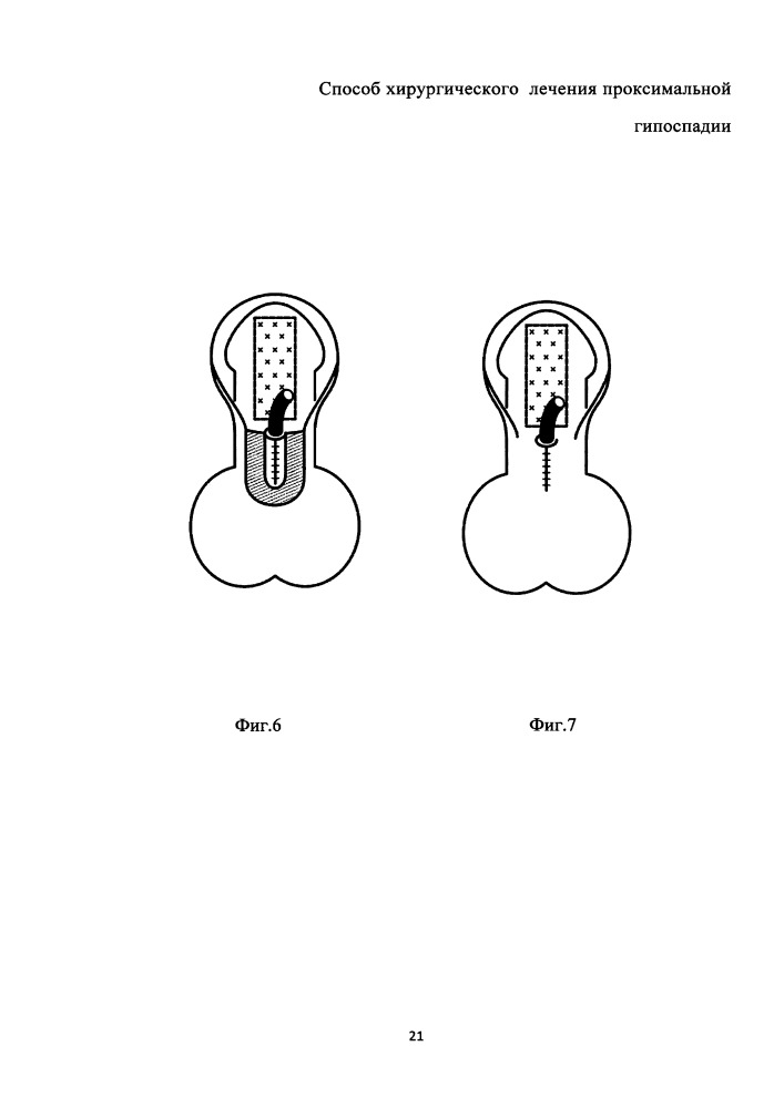 Способ хирургического лечения проксимальной гипоспадии (патент 2665545)