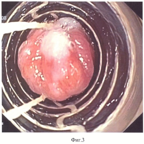 Способ эндоскопического лечения пищевода барретта (патент 2405495)
