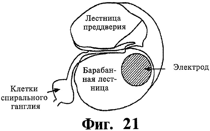 Имплантируемое устройство и способ доставки текучего лекарственного препарата в ткань (патент 2423154)