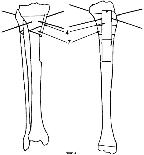 Способ хирургического лечения деформации длинных трубчатых костей при экзостозной хондродисплазии у детей и подростков (патент 2319466)