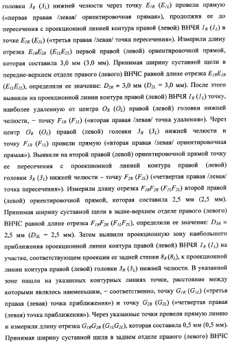 Способ определения оптимальной высоты прикуса (патент 2354300)