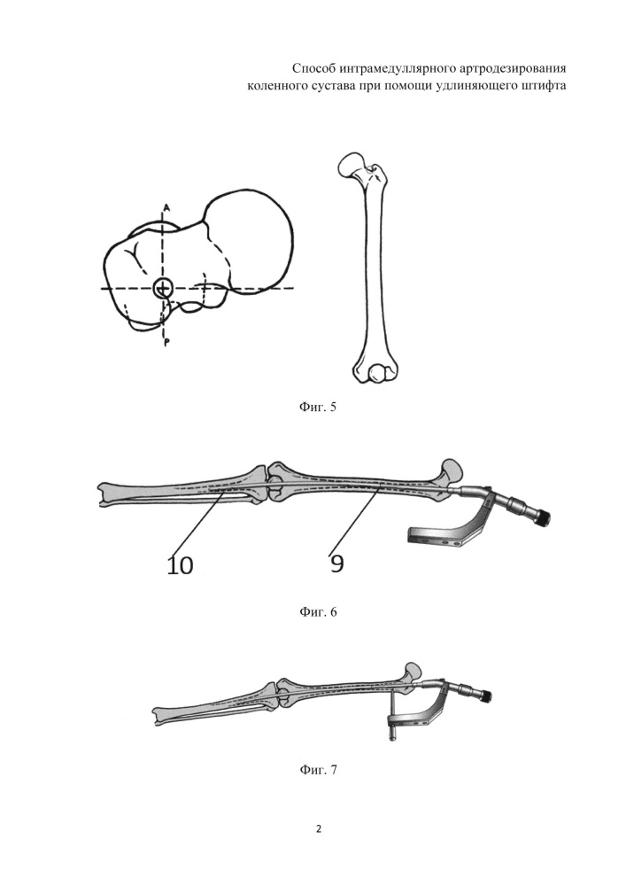 Способ интрамедуллярного артродезирования коленного сустава при помощи удлиняющего штифта (патент 2624674)