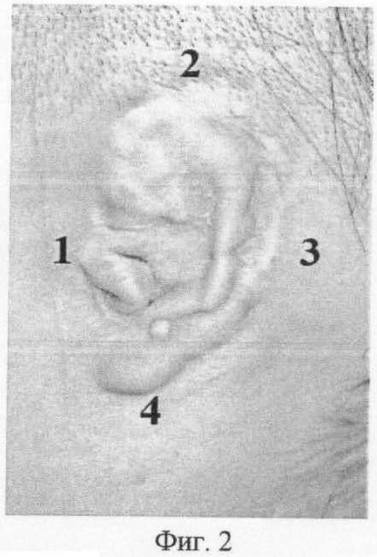 Способ определения кожной микроциркуляции в околоушной области у больных с врожденными пороками уха и приобретенными деформациями ушной раковины (патент 2462994)