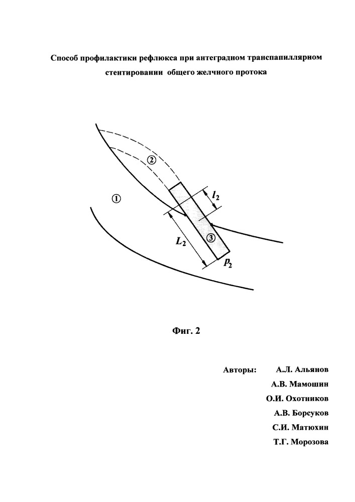 Способ профилактики рефлюкса при антеградном транспапиллярном стентировании общего желчного протока (патент 2652738)