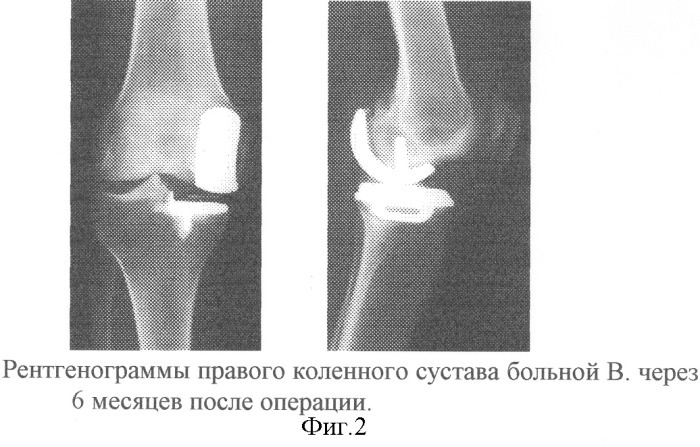 Способ лечения изолированного дегенеративно- дистрофического поражения внутреннего отдела коленного сустава (патент 2246912)